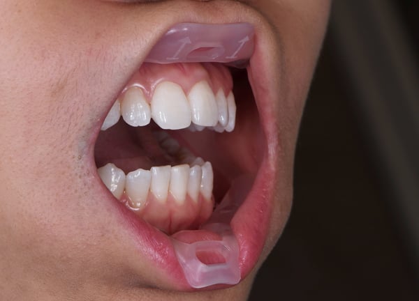 The Umbrella dental cheek retractor in a mouth half-way open
