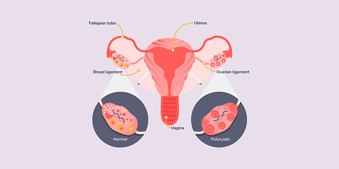 PCOS and Obesity correlation