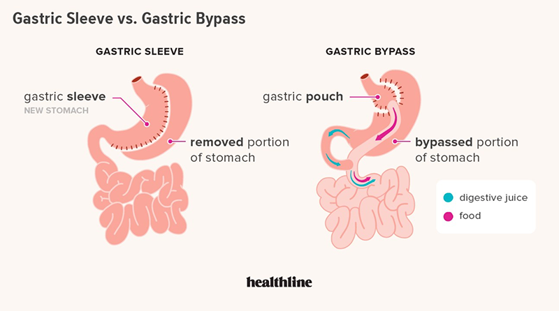 Gastric Bypass vs. Gastric Sleeve Comparison