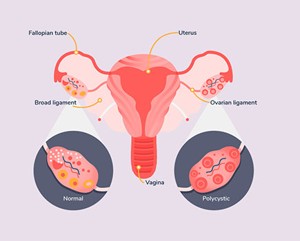 What is PCOS and how it affects obesity