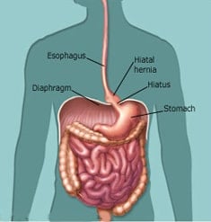 hiatal hernia weight loss surgery