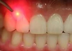 dental-lasers